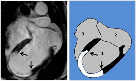Descifran el mecanismo por el que un fármaco conocido hace décadas reduce el tamaño del infarto Descifran el mecanismo por el que un fármaco conocido hace décadas reduce el tamaño del infarto