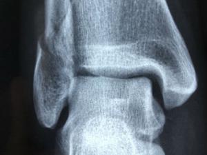 Descubren un nuevo ligamento en el tobillo que no está en los manuales de anatomía