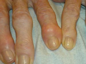 La artrosis es un efecto colateral de la lucha por la supervivencia del ser humano