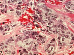 A cada mujer se le administró tratamiento con tamoxifeno o inhibidores de la aromatasa durante cinco años y, al final de ese tiempo, el cáncer desapareció. Imagen: células de cáncer de mama. / Dr. Cecil Fox (Photographer), National Cancer Institute, National Institutes of Health (FLICKR)