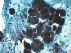 Micrografía de un melanoma. / Nephron (WIKIMEDIA)