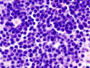 Mieloma múltiple: aspirado de médula ósea; tinción con hematoxilina-eosina. / KGH (PIXABAY)