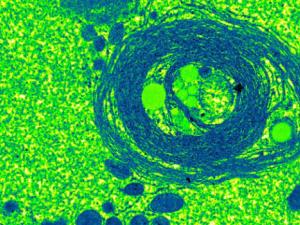 Hallan un nuevo vínculo entre el Síndrome Metabólico y el cáncer hepático