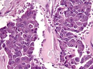 Micrografía de muy alta ampliación de un carcinoma de células acinares del páncreas. Tinción de H & E. / Nephron (WIKIMEDIA)