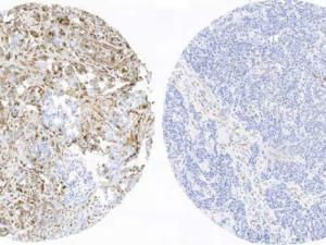 Tejido mamario de una paciente con recaída y que presenta los marcadores de fosforilación activos (izquierda; color marrón intenso), frente al tejido procedente de una paciente sin recaída y que no presenta estos marcadores activos (derecha). /CNIO
