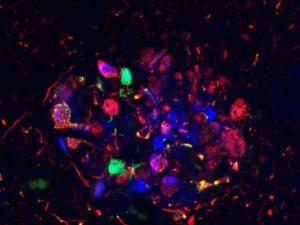 Imagen de una placa senil obtenida con microscopía láser confocal de la región CA1 del hipocampo de un paciente con enfermedad de Alzheimer. / CSIC