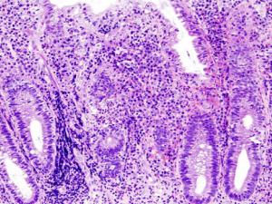 Imagen histopatológica de la etapa activa de la colitis ulcerosa. / KGH (WIKIMEDIA)