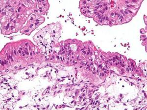 Micrografía de un tumor ovárico. / Nephron (WIKIMEDIA)