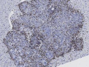 resultado de la inhibición de TGF-beta más inmunoterapia; esta combinación de tratamientos potencia la actividad del sistema inmune contra el tumor metastásico. / Daniele Tauriello (IRB Barcelona)