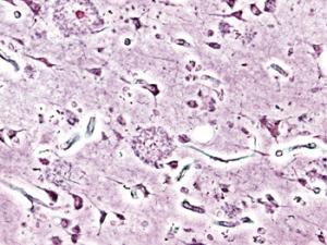 Imagen histopatológica de placas seniles vista en la corteza cerebral de un paciente con la enfermedad de Alzheimer. Impregnación con plata. / KGH (WIKIMEDIA)