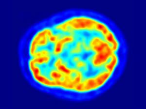 Una tomografía por emisión de positrones con fluorodesoxiglucosa (18F) (FDG): áreas más calientes reflejan incremento en la captación de glucosa; y puede revelar actividad dopaminérgica mermada en los ganglios basales y facilitar el diagnóstico. / Jens Maus (WIKIMEDIA)