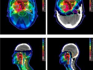 Comparación de las distribuciones de dosis entre los planes IMPT (derecha) e IMRT (izquierda) en NPC T4N1M0 en vistas axiales (arriba) y sagitales (abajo). Las líneas punteadas denotan el 95% de la dosis prescrita para GTV-T. / Taheri-Kadkhoda et al. Radiation Oncology 2008 3:4 doi:10.1186/1748-717X-3-4 (WIKIMEDIA)