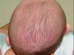 Smartphones para medir la deformación craneal de lactantes y mejorar su diagnóstico