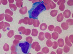 Mononucleosis infecciosa. / Ed Uthman, MD. (WIKIMEDIA)