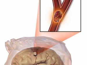 Un nuevo fármaco para el tratamiento del ictus hemorrágico