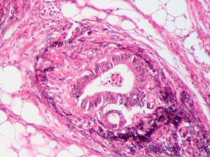 Cáncer colorrectal. / Patho (WIKIMEDIA)