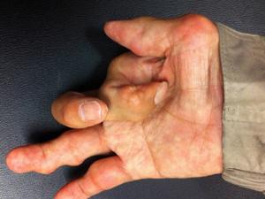 Artritis en la mano. / handarmdoc (FLICKR)