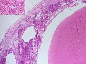 Histopatología de la meningitis bacteriana: caso de autopsia de un paciente con meningitis neumocócica. / Marvin 101 (WIKIMEDIA)