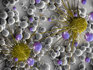 Células de cáncer de cerebro. / BCNU (FLICKR)