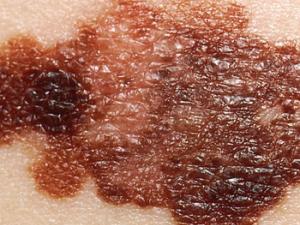 Melanoma. / National Cancer Institute (WIKIPEDIA)